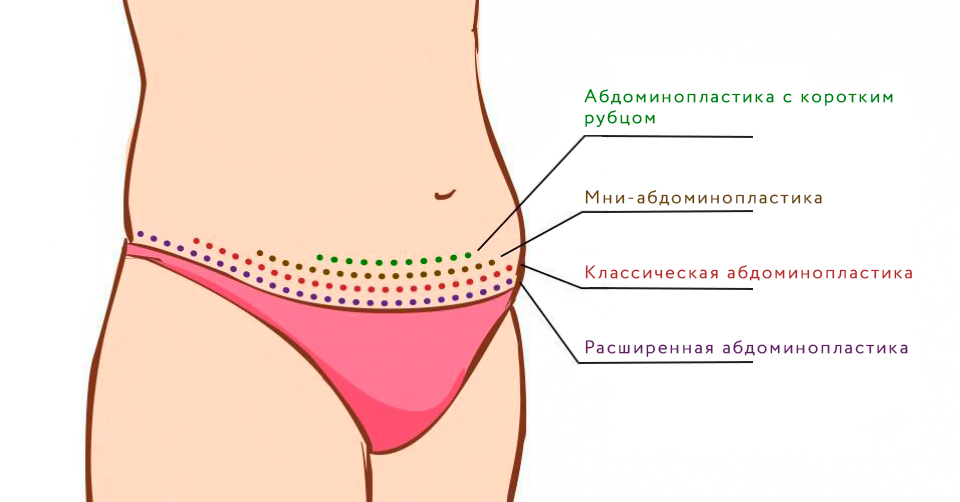 типы абдоминопластики