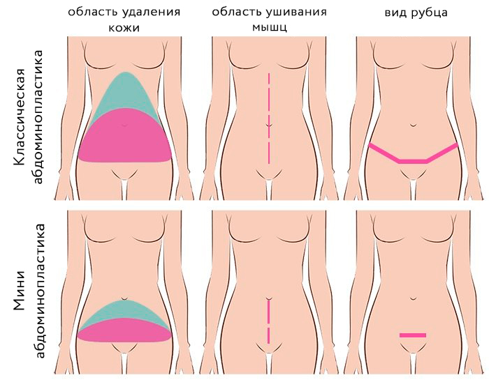 миниабдоминопластика и классическая абдоминопластика