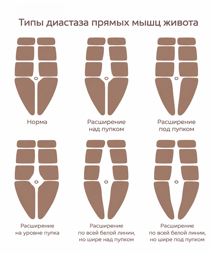 виды диастаза